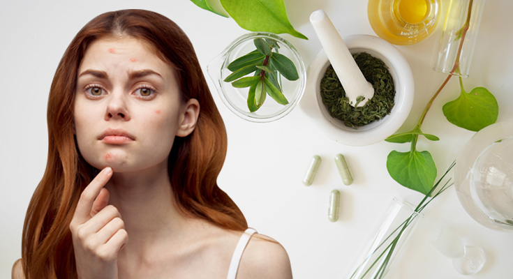 Top Ayurvedic Therapies to Cure Acne (Pimples)
