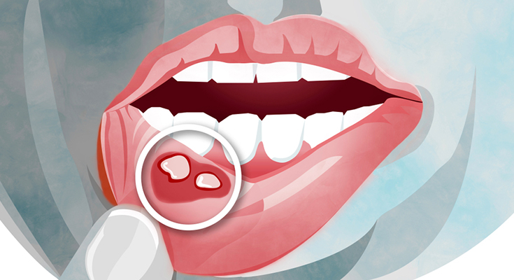 मुंह के छालों से बचने के कमाल के घरेलू उपाय! Home Remedies for Mouth Ulcer