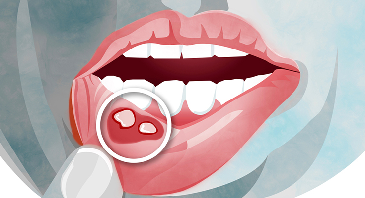 Mouth Ulcer