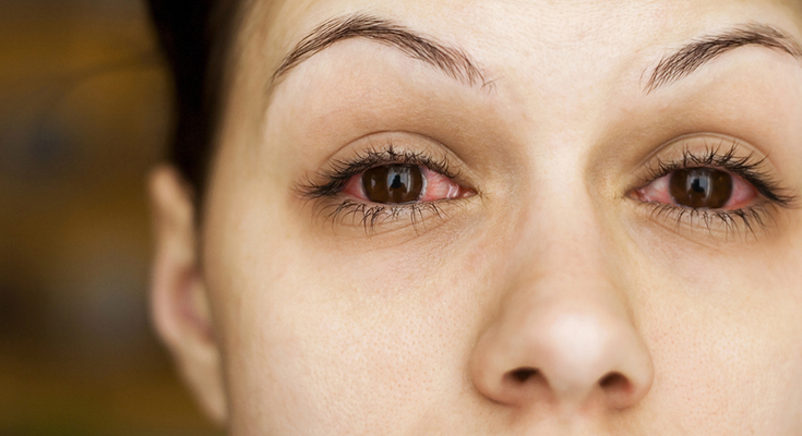 These Home Remedies for Eye Infection Work Amazing!