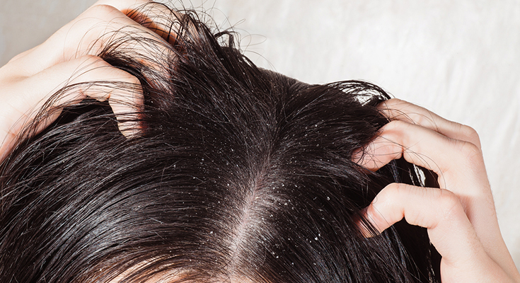 Sleeping With Wet Hair Can It Cause Dandruff  Fungal Infections