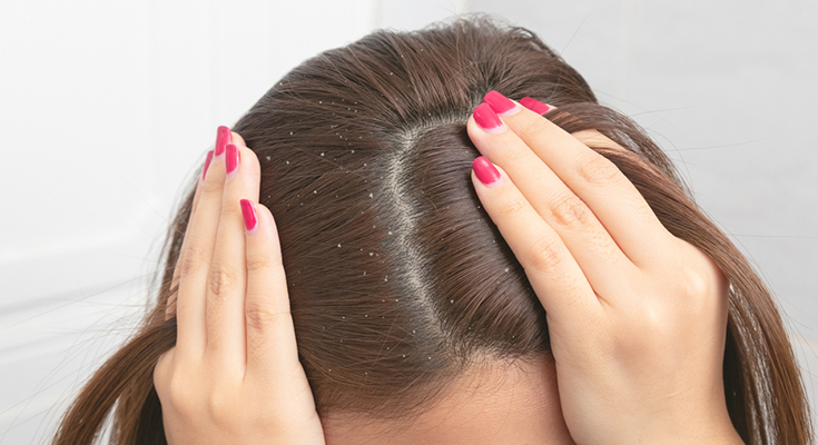 Dandruff In Winter Is Not Going Be An Issue – Reasons Told By Experts!