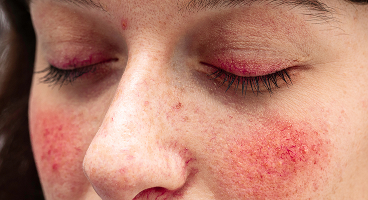 चेहरे पर लाल धब्बों
