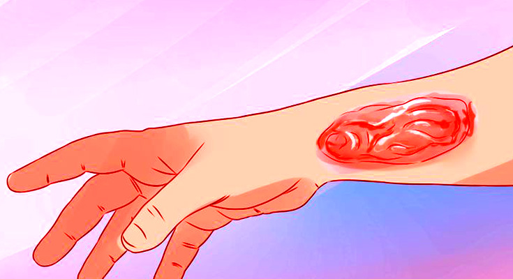 स्किन बर्न होने पर क्या करना चाहिए और स्किन बर्न की 3 स्टेज क्या हैं?