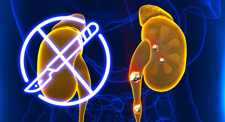 kidney stone treatment without surgery