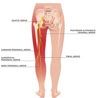 Sciatica Treatment